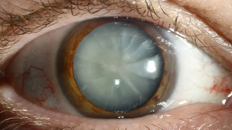 Cataract: Symptoms, Causes, Treatment & Recovery – Complete Guide for Patients featured image